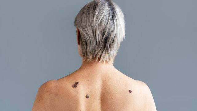 Menilik Kepribadian Berdasarkan Letak Tahi Lalat, Ada di Dagu Artinya Apa?