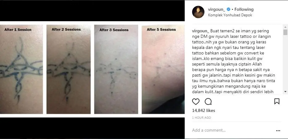 Foto unggahan Virgoun yang menyorot penghapusan tato. (Instagram - @virgoun_)