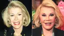 Joan Rivers mengaku melakukan sederet operasi plastik. Menurut kamu lebih cantik yang dulu atau sekarang? (StarCrush)