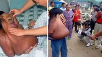 Idap Tumor Langka Seberat 15 Kg, Pria Ini Dijuluki Manusia Gajah