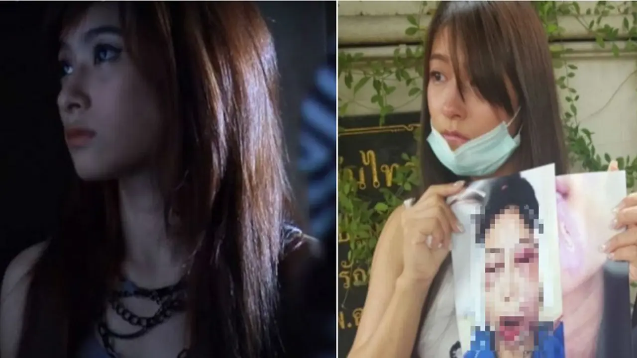 Ingin Cantik, Wajah Model Ini Malah Hancur Habis Operasi Plastik