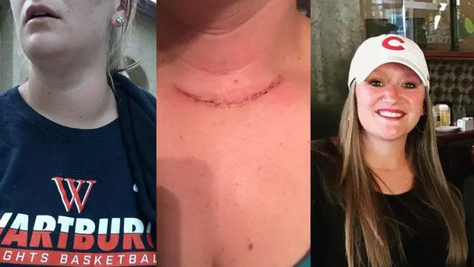 [Bintang] Kanker Tiroid