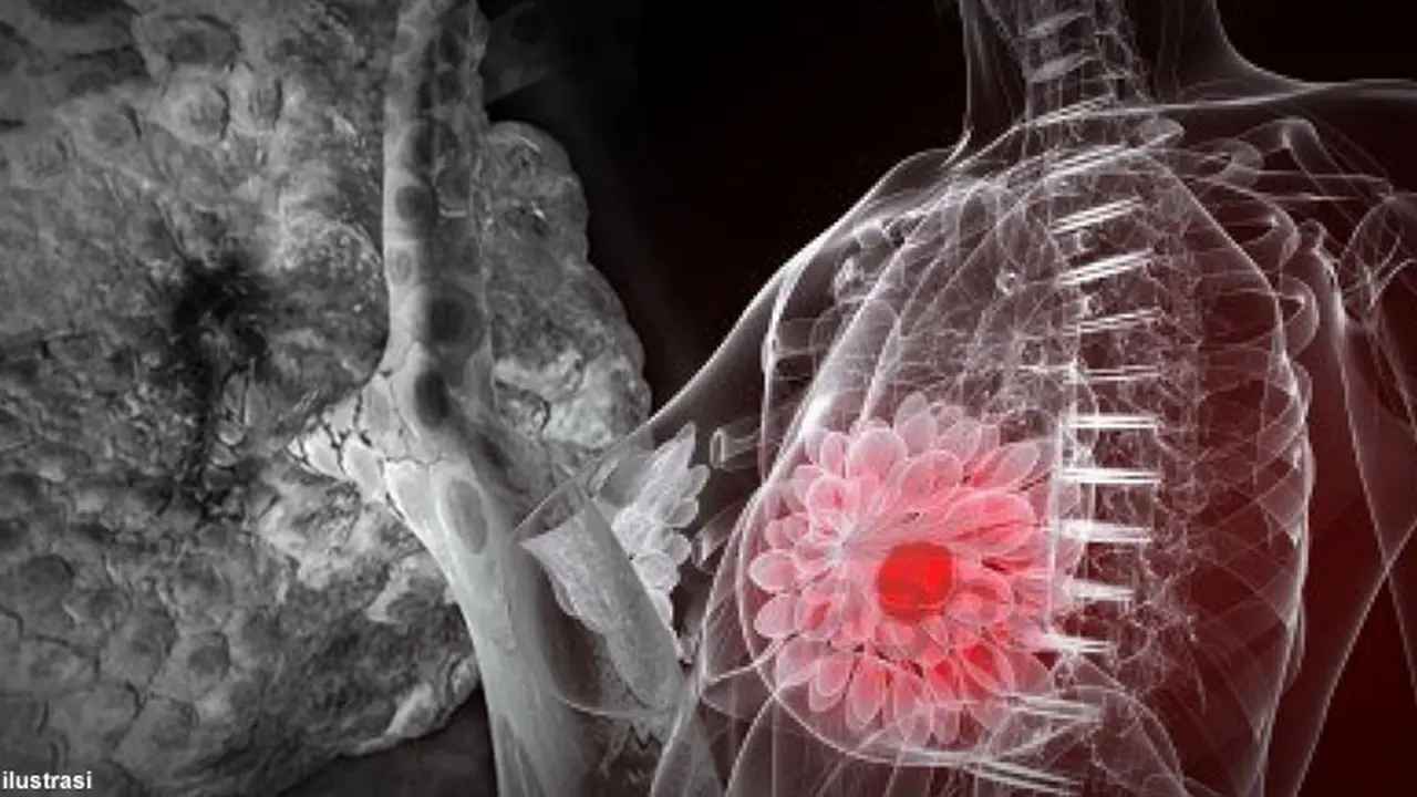 tumor-kanker-payudara130513b.jpg