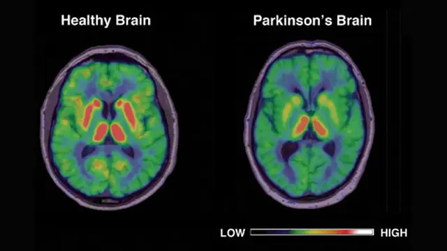 Parkinson