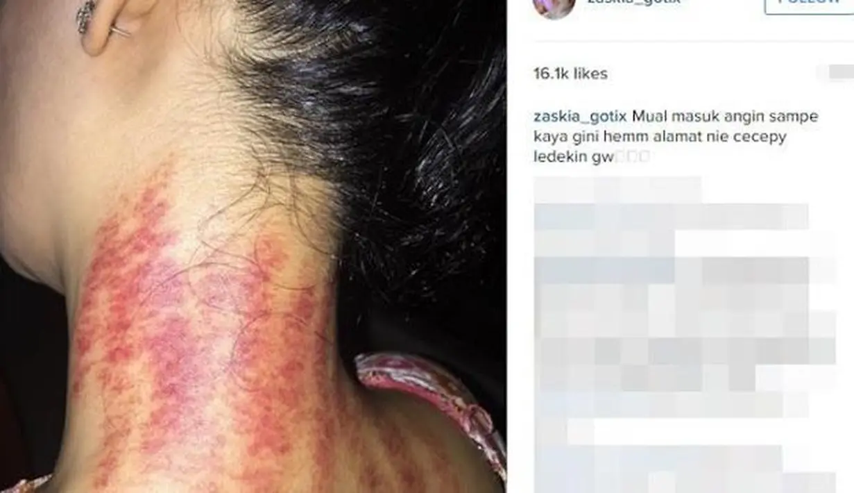 Seleb cantik pamer usai kerokan (Sumber: Instagram/zaskia_gotix)