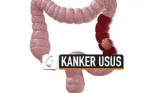 THUMBNAIL KANKER USUS