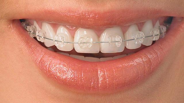 Bahaya Mengintai Saat Pasang Behel di Ahli Gigi