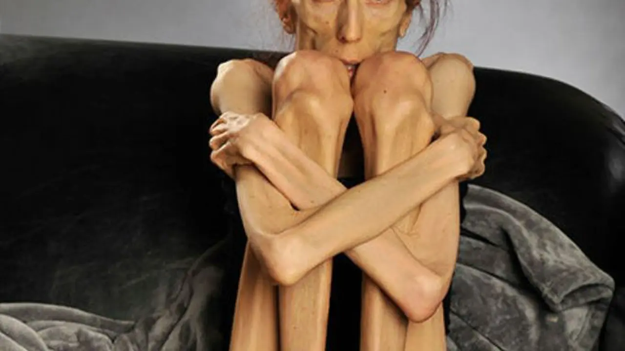 Rachael Farrokh, Penderita Anorexia yang Sekarat dan Ingin Insyaf