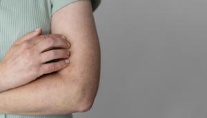 campak dapat menyebabkan anak kehilangan banyak cairan tubuh. credits: freepik