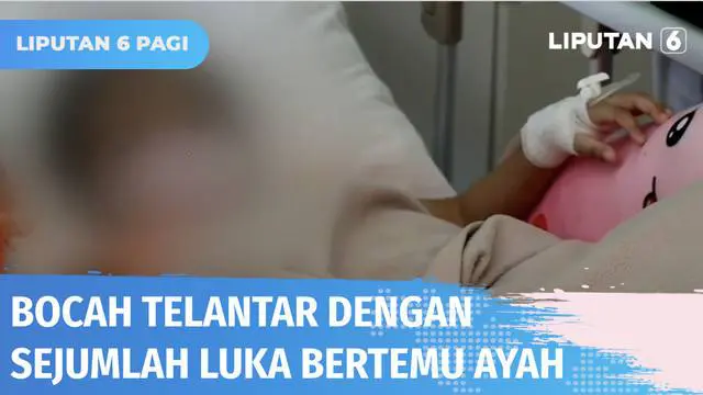 Setelah beredar luas di sosmed, bocah yang telantar di jalan dengan sejumlah luka akhirnya bertemu ayah kandungnya di RSUD Wangaya, Bali. Diduga bocah dianiaya sang ibu setelah berpisah dari ayahnya.