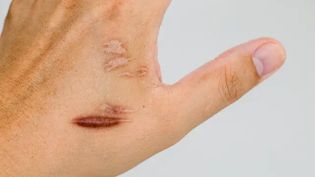 Cara Menghilangkan Keloid