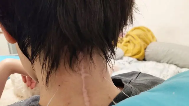 6 Potret Perjuangan Laura Anna Hadapi Spinal Cord Injury, Fisioterapis Hingga Akupuntur