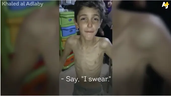Tanpa Makanan, Anak-anak Suriah Tinggal Tulang Berbalut Kulit