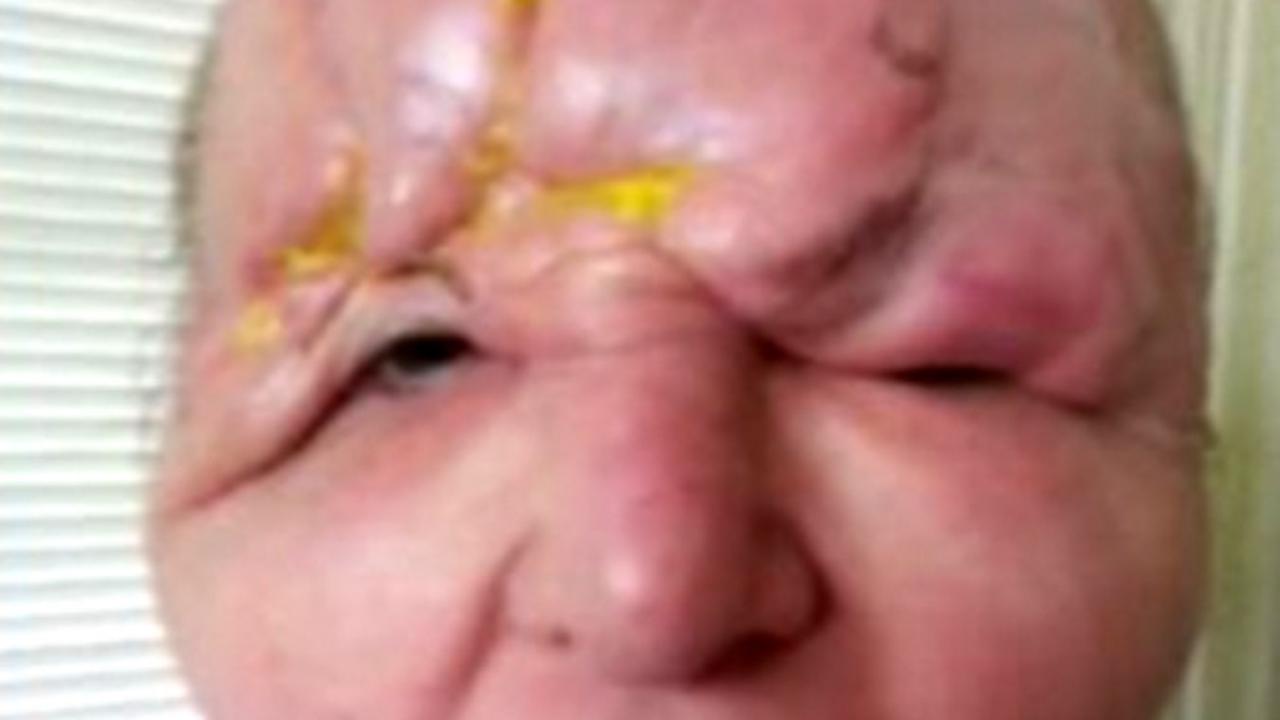 Salah suntik filler wajah wanita ini jadi rusak