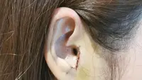 Bagian telinga perempuan yang dipotong saat menjalani operasi hidung di China (Dok.The Paper/Komarudin)