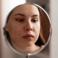 Seorang perempuan sedang bercermin melihat jerawat yang ada di wajahnya (Foto Dok: Freepik/freepik).
