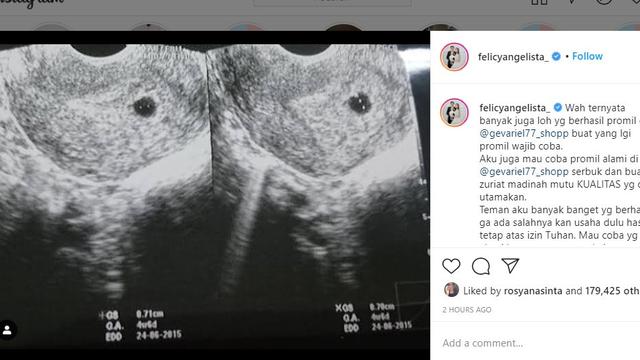 Felicya Angelista pamer foto hasil USG dua hari usai menikah dengan Caesar Hito (https://www.instagram.com/p/CJ5BC4enJ3z/)