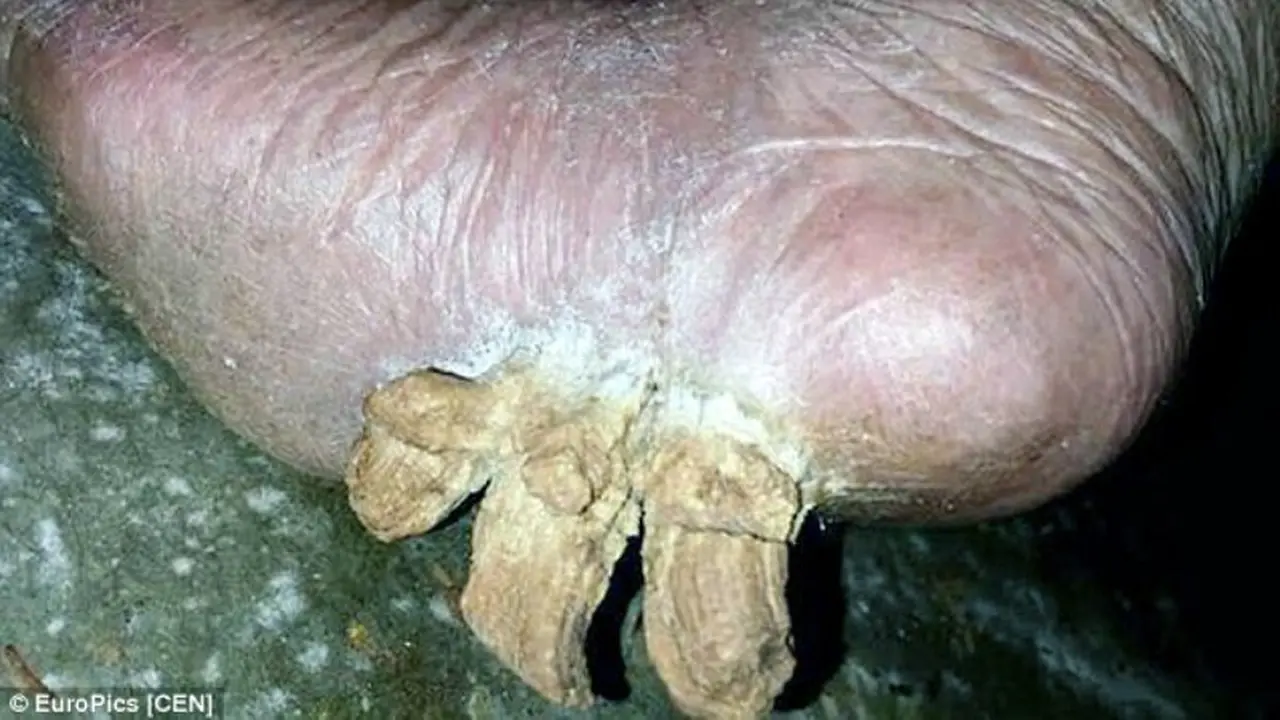 Tanduk Tumbuh dari Kaki Wanita Ini