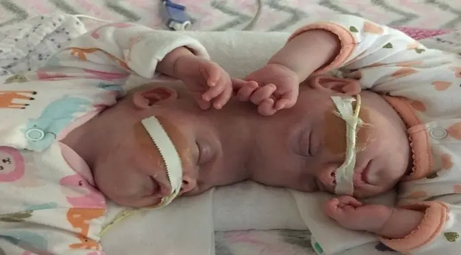 Bayi kembar siam dengan kepala bersatu berhasil dipisahkan. (Foto: WHNT News)