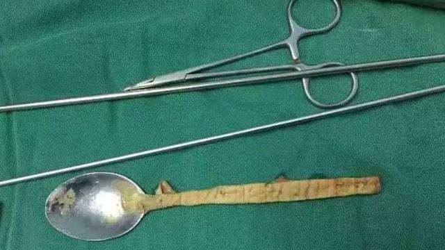 Akibat Mabuk, Pria Ini Telan Sendok Logam dan Tersangkut di Kerongkongan