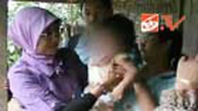 Pemkab Trenggalek Perangi Bibir Sumbing