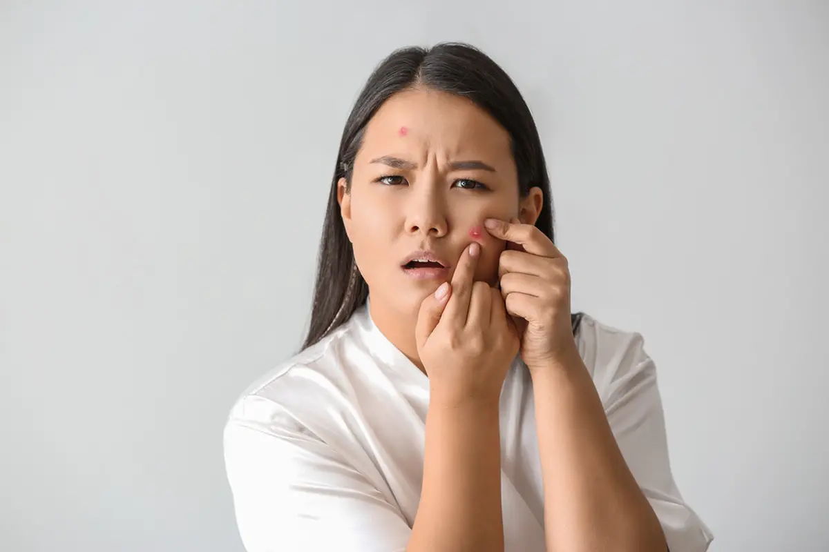Tips Mengempeskan Jerawat Matang dengan Cepat tanpa Perlu Dipencet