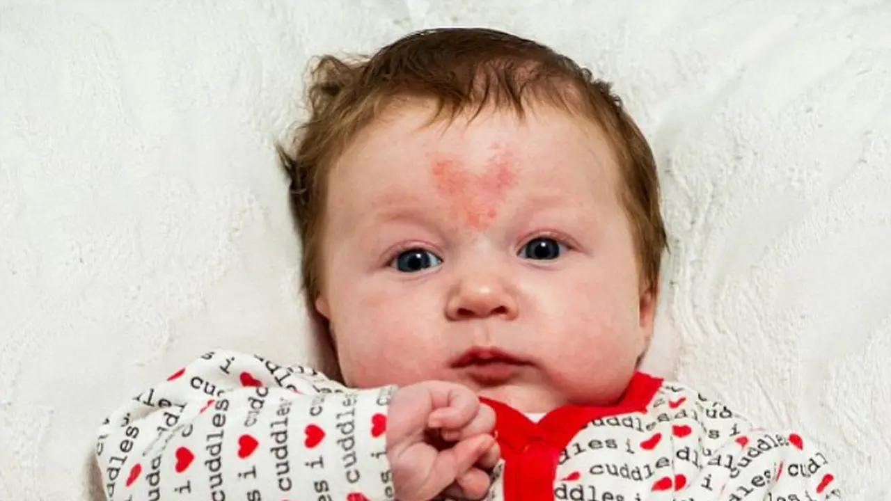 Sambut Valentine, Bayi Imut Punya Tanda Lahir Bentuk Hati, Aw!