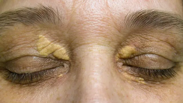Xantoma, Penyakit Kulit Akibat Kolesterol Tinggi (Nau Nau/Shutterstock)