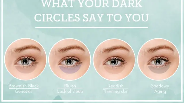 4 Sebab Dan Solusi Lingkaran Gelap Di Bawah Mata Beauty Fimela Com