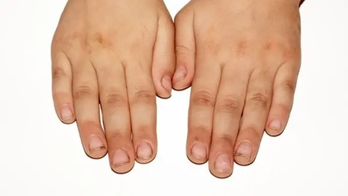 Garis Hitam Pada Kuku Pertanda Kanker?