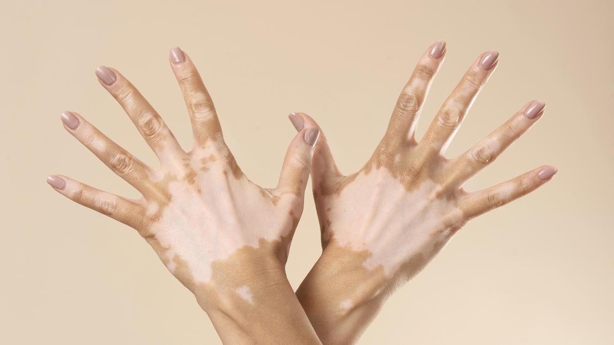 Harapan Baru untuk Penderita Vitiligo: Fototerapi Exciplex Clarteis Tingkatkan Kepercayaan Diri dan Efektivitas Pengobatan