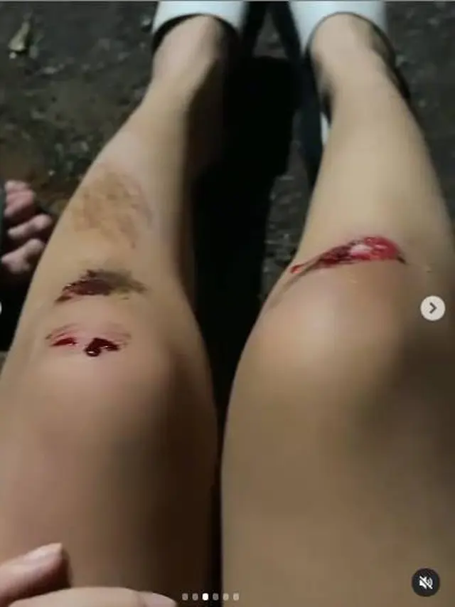 Brisia Jodie dan Julia Jacob Alami Kecelakaan, Ini 7 Potretnya Saat di Rumah Sakit