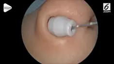 Momen saat sebuah mainan diambil dari hidung seorang bocah di Malaysia viral. Mainan ini masuk tak sengaja dan mengancam keselamatan sang bocah.