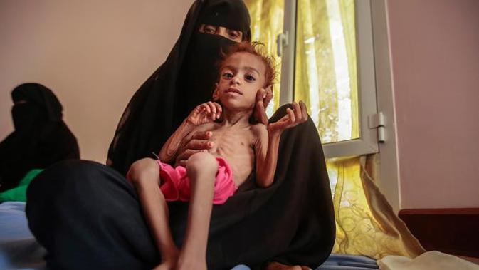 PBB: Perang Saudara Picu Pertumbuhan Terhambat Banyak Balita di Yaman - Liputan6.com