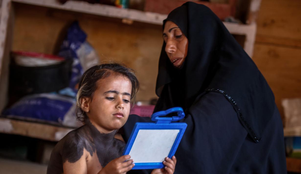 Houra melihat cermin di rumahnya di desa Wahed Haziran, Provinsi Diwaniya, Irak, (17/3). Setiap hari, orang tua Haura memakaikan baju lengan panjang dan kerah tinggi untuk menutupi penyakit kulit langka yang dialaminya. (AFP Photo/Haidar Hamdani)