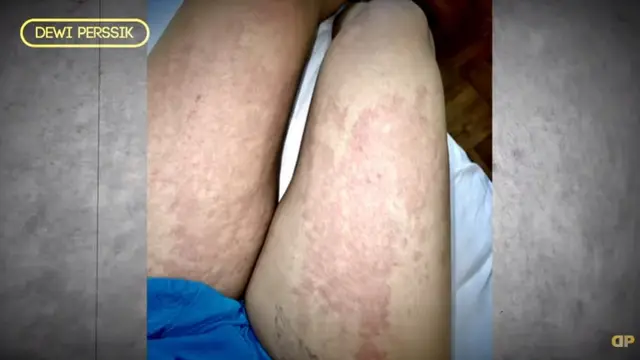 7 Potret Dewi Perssik saat Alami Gejala Corona Covid-19, Penuh Ruam Merah
