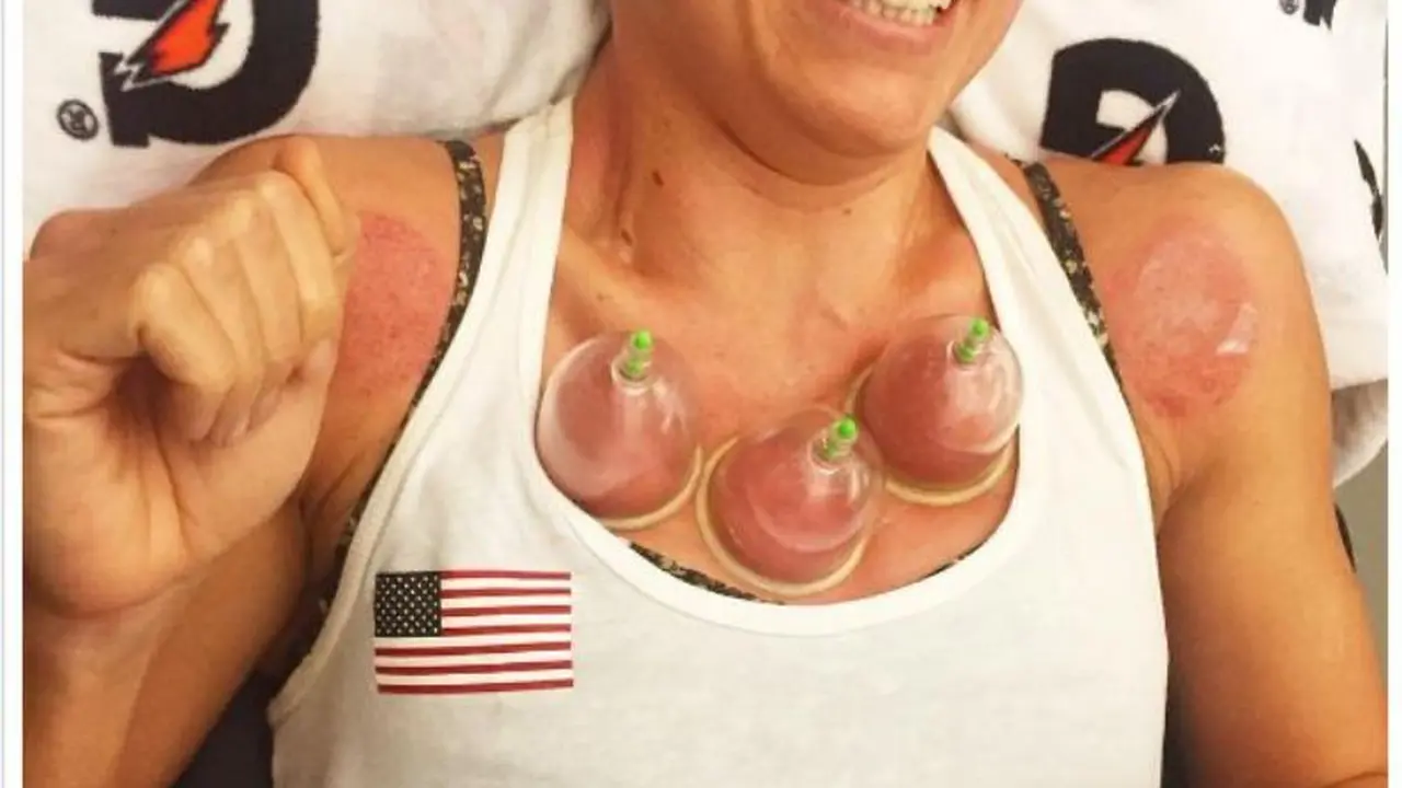 Atlet renang asal Amerika Serikat Natalie Coughlin menjalani terapi bekam. (Instagram/nataliecoughlin)