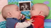 Saling Menguatkan, Bayi Kembar Ini Bergandengan Sejak di Rahim
