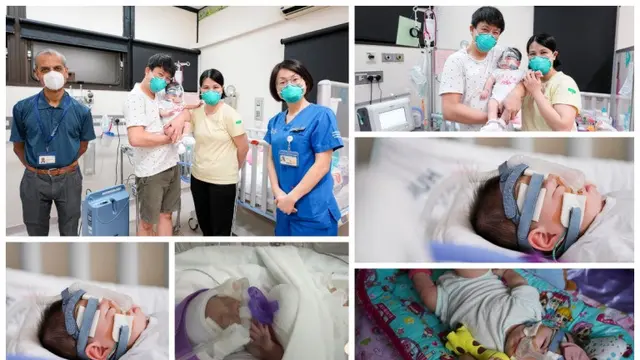 Lahir Prematur, Bayi Ini Jadi Paling Ringan di Dunia dengan Berat 212 Gram
