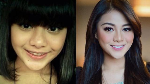6 Transformasi Seleb Setelah Perbaikan Gigi, Terbaru Elly Sugigi