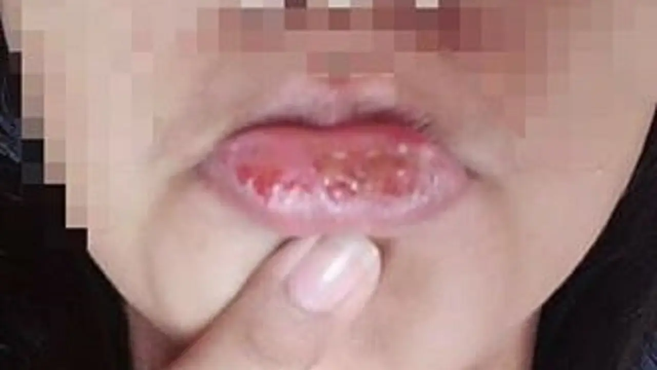 [Bintang] Infeksi