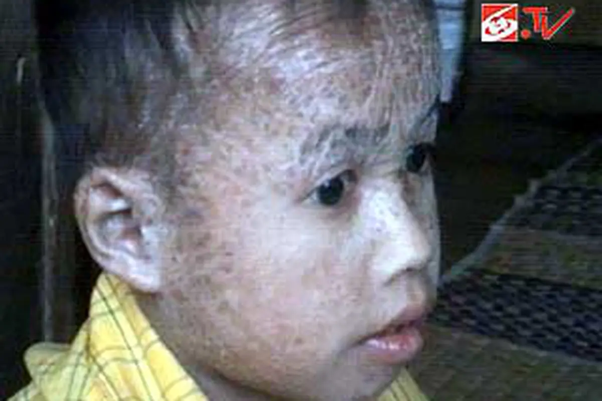 Tubuh Rohmat Dipenuhi Sisik Seperti Ikan
