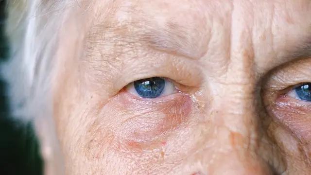 Ilustrasi penyakit mata Age-Related Macular Degeneration atau AMD.