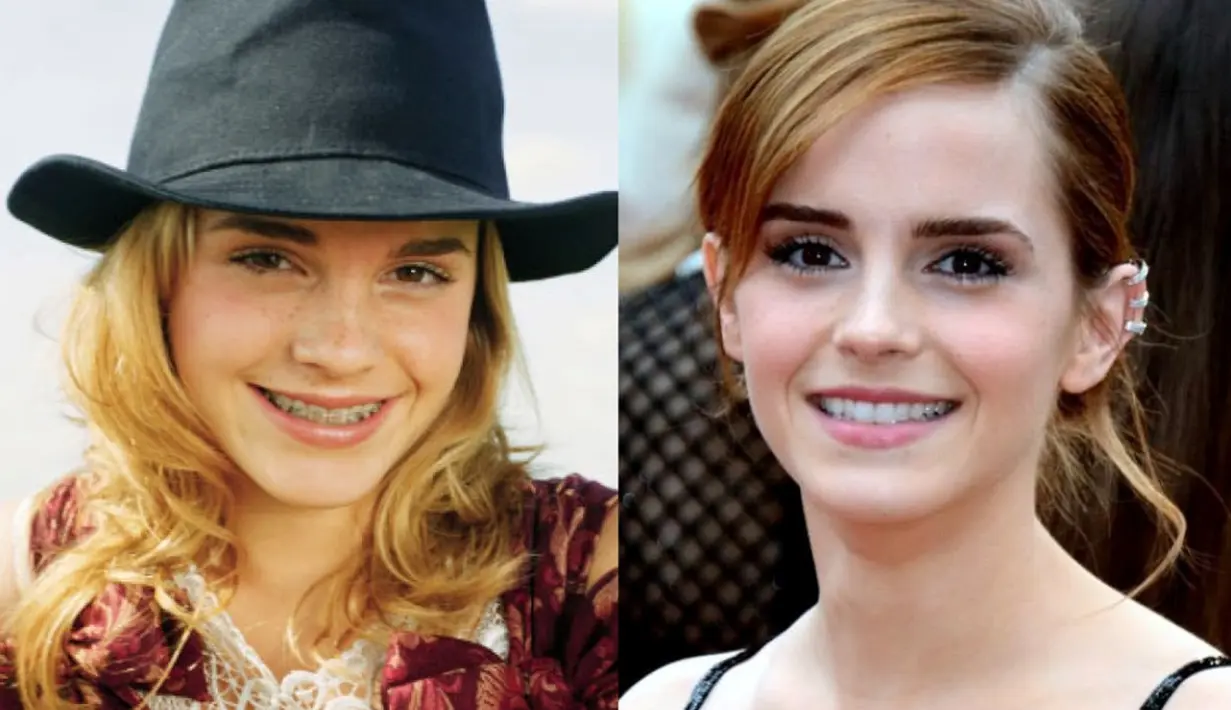 Emma Watson menggunakan kawat gigi di awal kariernya. (Pinterest)