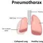 Pneumothorax