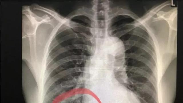 Tak Sengaja Menelan Paku