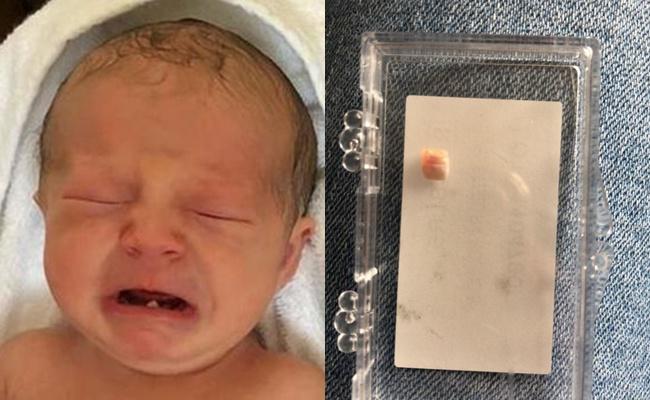 Bayi Isla yang mencabut giginya di usia 12 hari/copyright Jasmin Heasman / SWNS.com