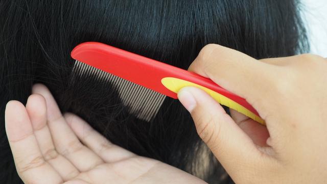 Cara Ampuh Membasmi Kutu Rambut dan Telurnya yang Bikin Kepala Gatal, Intip Yuk