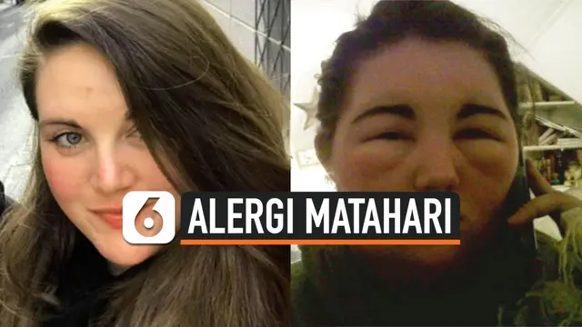 VIDEO: Wanita Ini Alergi Sinar Matahari Akibat Warnai Rambut