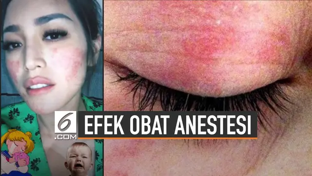 Jessica Iskandar alami ruam di area pipi karena reaksi alergi anestesi.